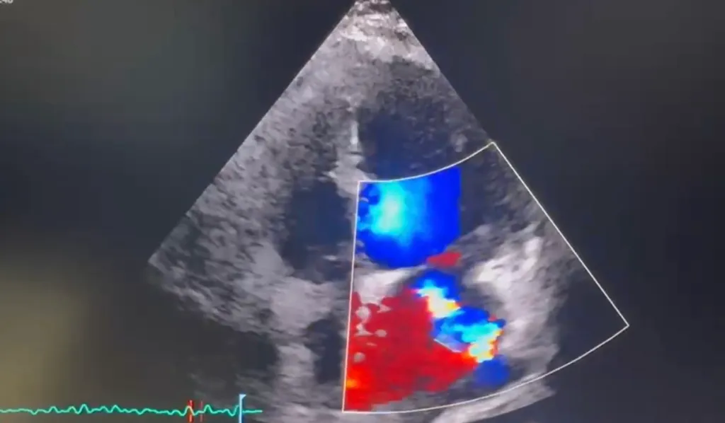 Severe Mitral Regurgitation Detected at the Bedside Following Pacemaker Lead Endocarditis