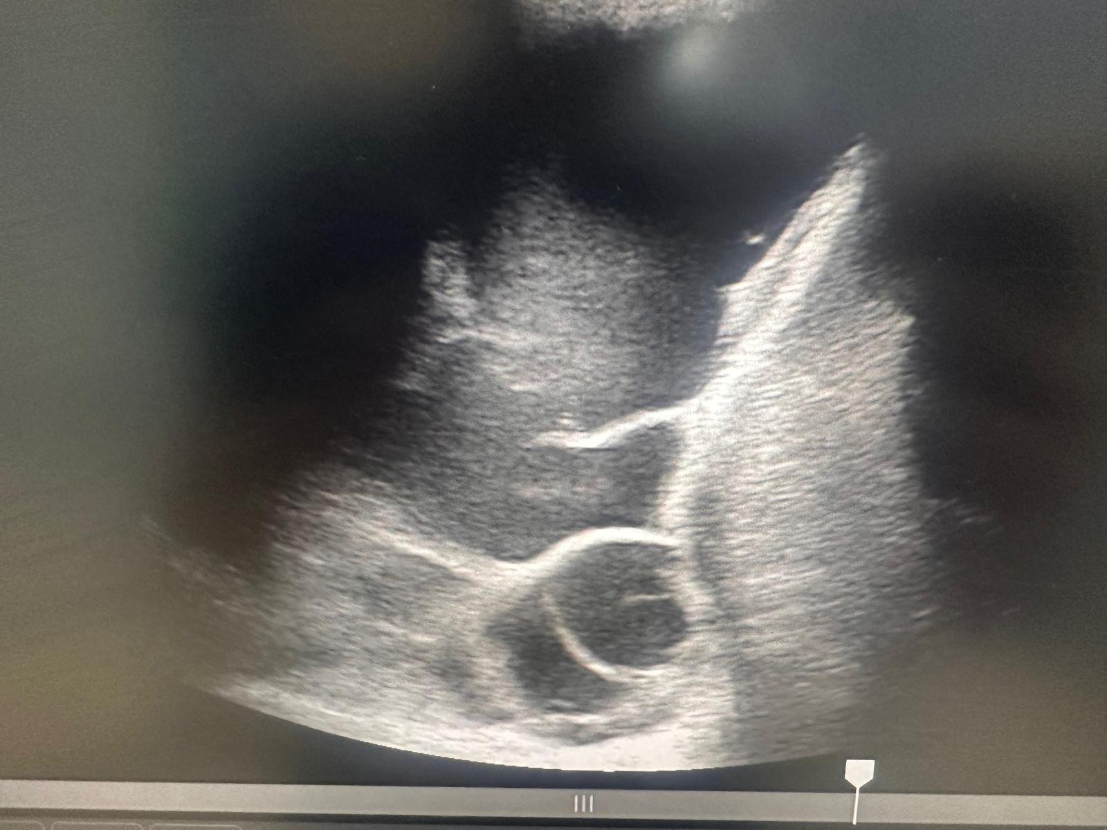 POCUS Identifies a Complex Right-Sided Pleural Effusion