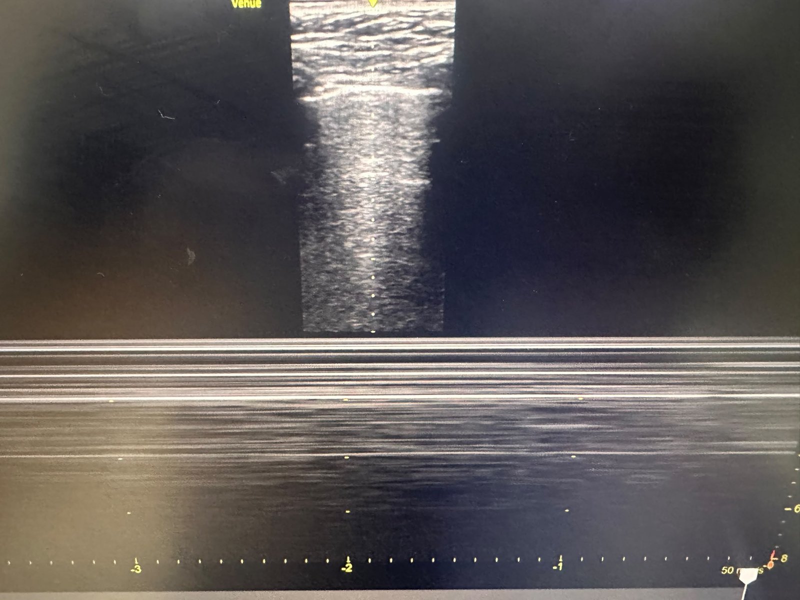 POCUS Provides an Immediate Diagnosis of Pneumothorax