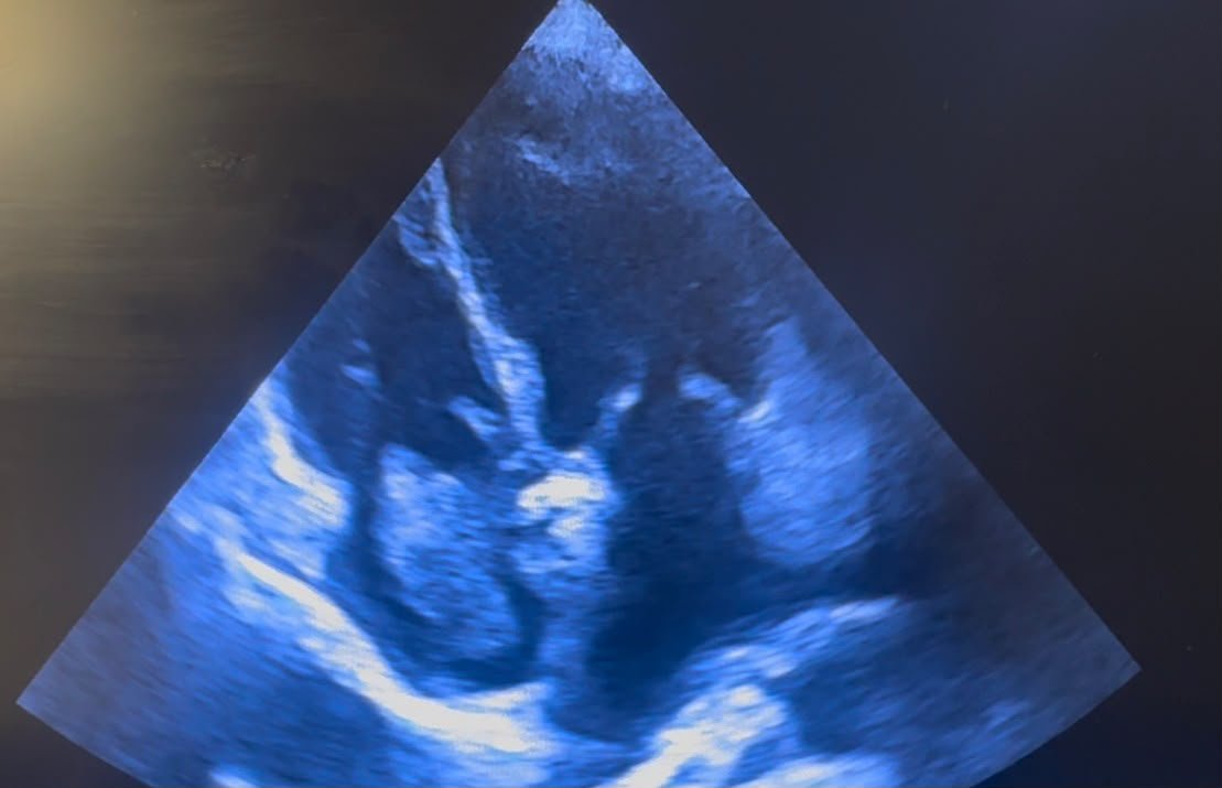 POCUS Reveals Right Ventricular Dilatation in Acute Pulmonary Embolism